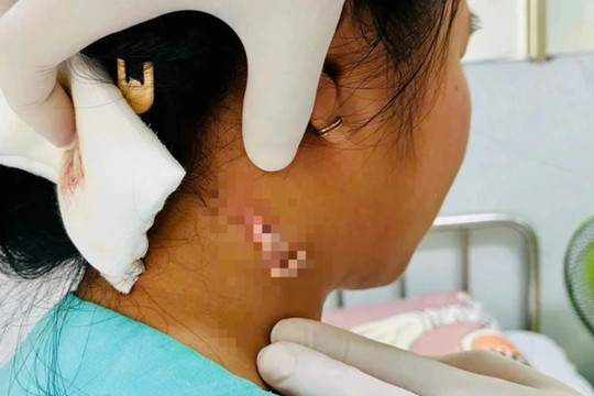 TPHCM: Phát hiện ca bệnh nhiễm 'vi khuẩn ăn thịt người'