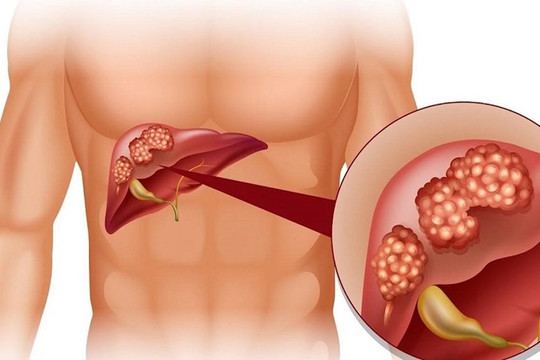 Bác sĩ Bệnh viện Bạch Mai cảnh báo 4 nhóm đối tượng có nguy cơ cao mắc ung thư tụy