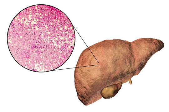 Chuyên gia phát hiện 'bom hẹn giờ' dẫn tới ung thư gan