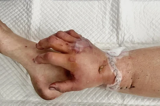 Ca phẫu thuật hy hữu: Nuôi sống bàn tay trên chân bệnh nhân, chờ ngày ghép lại tay