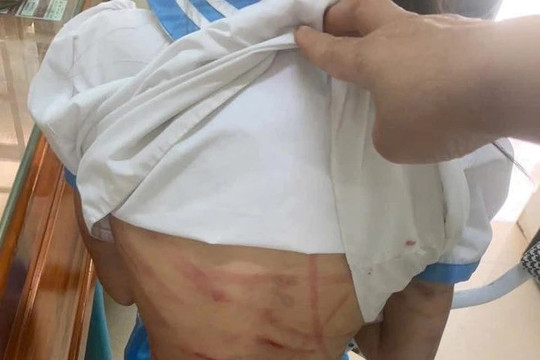 Bé gái lớp 5 nghi bị cha dượng bạo hành: Vùng đầu chảy máu, chân khó cử động