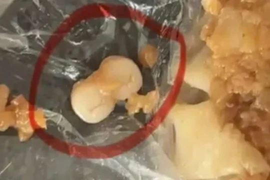 Liên tiếp phát hiện răng người trong xúc xích, dim sum: Người tiêu dùng 'sốc' đặt câu hỏi, nguyên liệu này từ đâu ra?