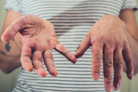 Loại virus đang bùng phát mạnh ‘vượt ngoài tầm kiểm soát’, tiếp tục gây nguy hiểm trong 25 năm tới