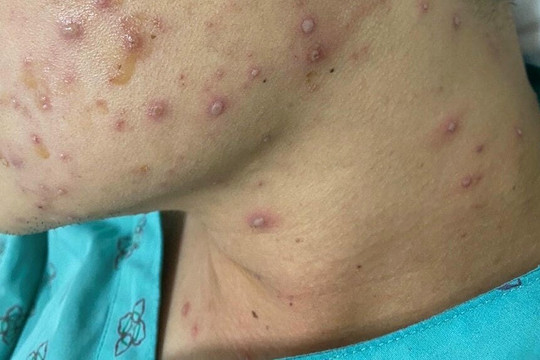 Căn bệnh lây nhanh đang bùng phát khi trời lạnh, hiện chưa có thuốc đặc trị