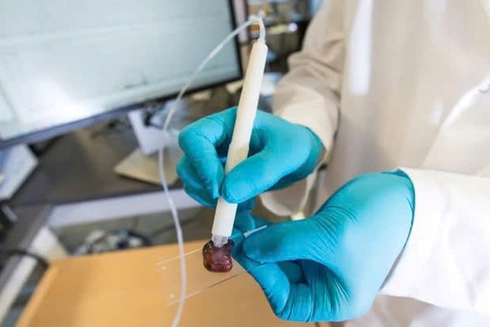 Bút phát hiện ung thư chỉ trong 10 giây chính thức được thử nghiệm lâm sàng tại bệnh viện