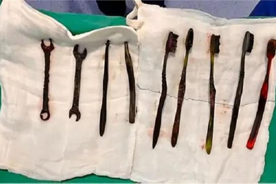 Mổ khẩn cấp, lấy 7 bàn chải đánh răng, 2 chiếc cờ lê trong bụng một người đàn ông 26 tuổi