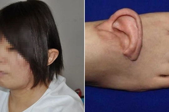 Chưa từng có trong lịch sử: Ca ghép tai người vào chân đầu tiên trên thế giới thành công, đánh dấu bước đột phá trong y học tái tạo