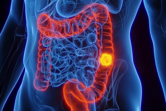 Nửa năm sụt 8kg, người phụ nữ bất ngờ phát hiện ung thư giai đoạn muộn