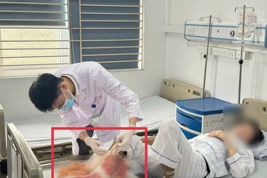 Đắp lá chữa bỏng suốt một tháng, người đàn ông suýt mất chân vì hoại tử lan tới xương