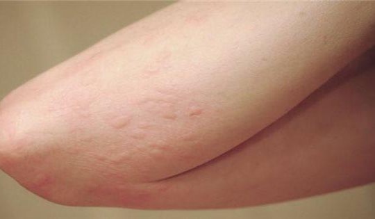 Tưởng chỉ ngứa da do thời tiết, người đàn ông đi khám phát hiện ung thư gan giai đoạn 3