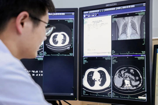 AI Trung Quốc có thể phát hiện ung thư và gần 150 bệnh lý, giúp bác sĩ giảm đáng kể thời gian phân tích ảnh chụp